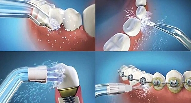 İmplant yaptıranların ağız bakımı da özel! Uzmanlar, implant çevresi için ağız duşlarını öneriyor…