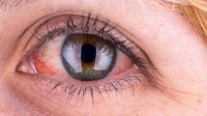 Yaz serinliği göz sağlığınızı tehdit etmesin: 6 koruyucu öneri