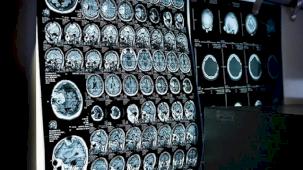 Ücretsiz kanser taramaları için SMS ile bilgilendirme dönemi