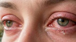 Baharın habercisi... Alerjik Konjonktivit